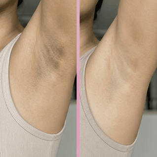 Peel Shot Amara™ | Spray Exfoliante para Manchas Corporales