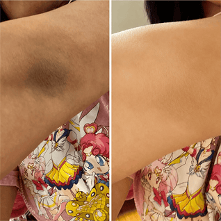Peel Shot Amara™ | Spray Exfoliante para Manchas Corporales